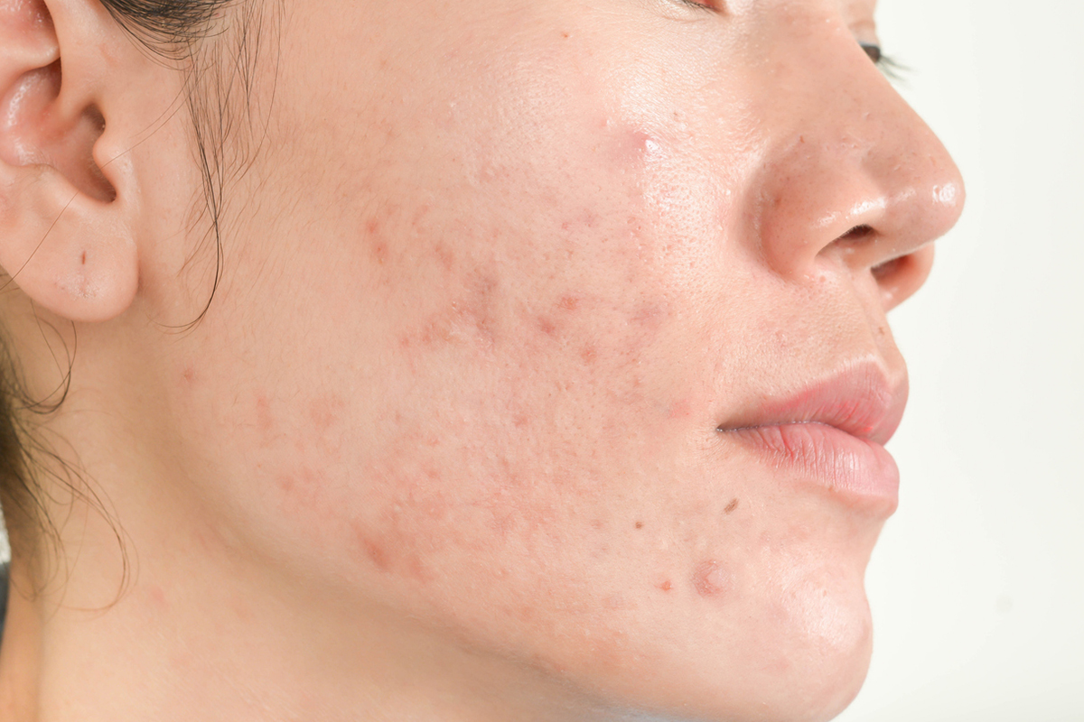 Acne on a young woman's face.