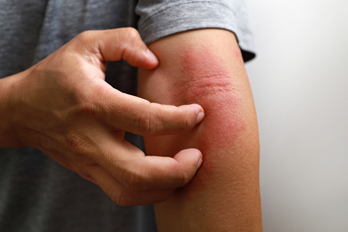 Dermatitis on an arm 