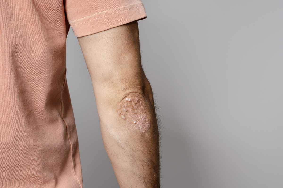 Psoriasis on an elbow of a young man. 