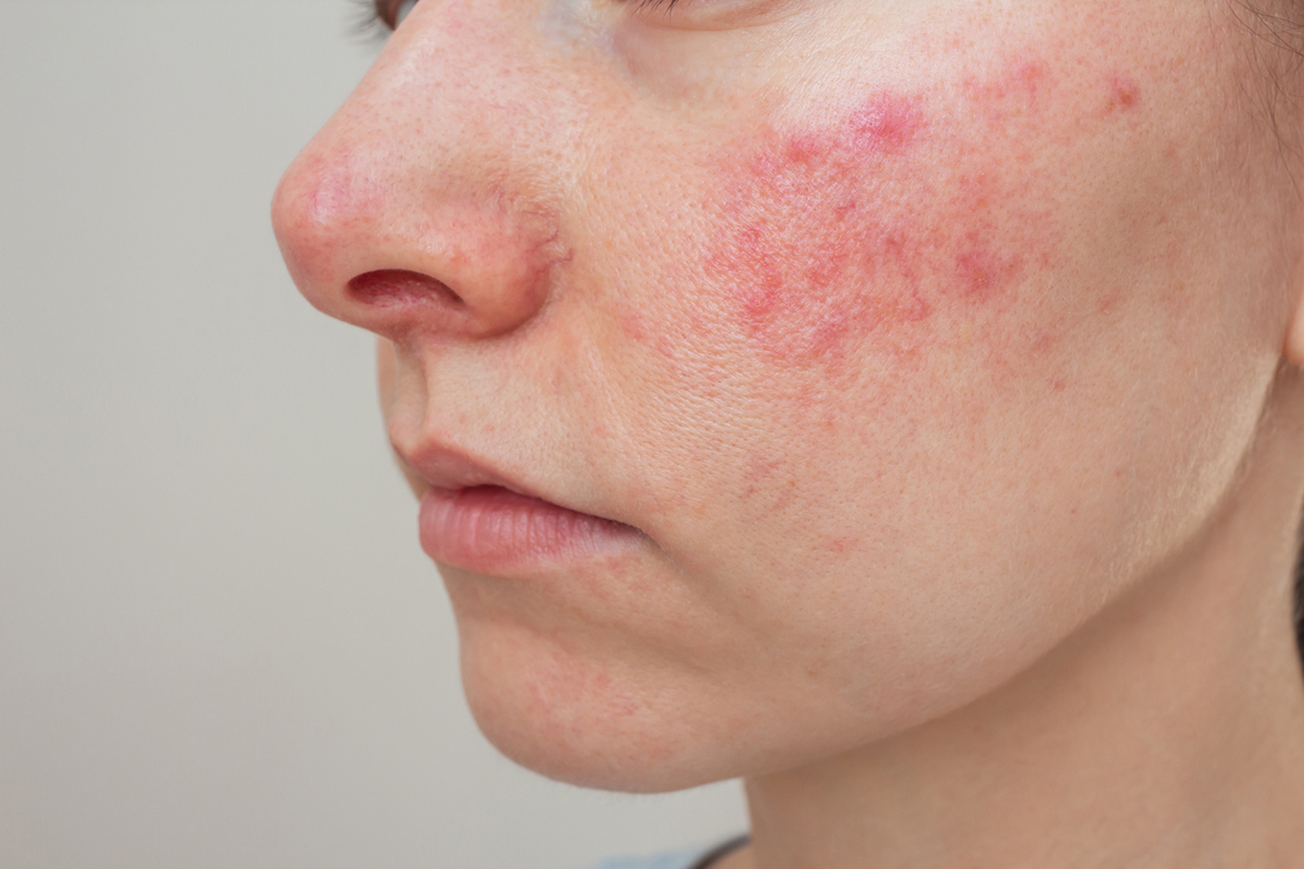 Rosacea on a woman's face. 