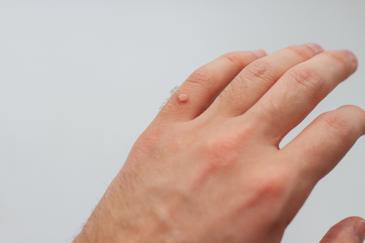 wart on hand finger isolated on white background.